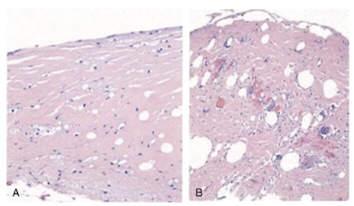 Breast implant associated illness