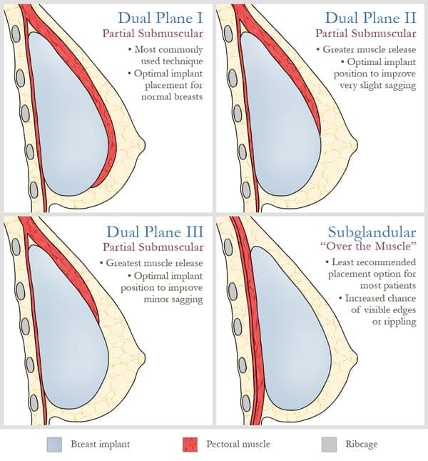 Dual plane breast augmentation