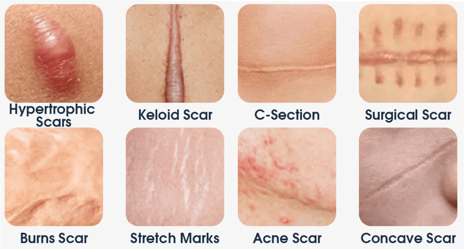 Scars