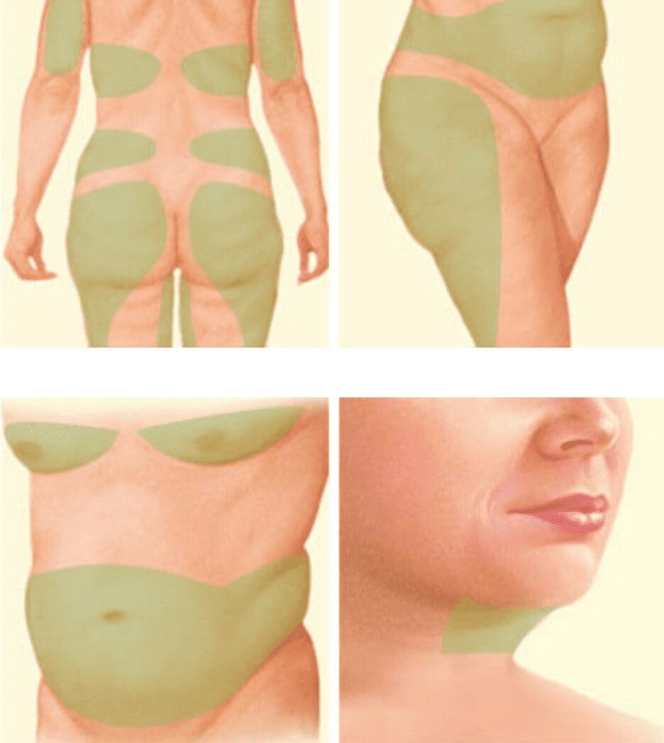 Different types of liposuction: what is important?