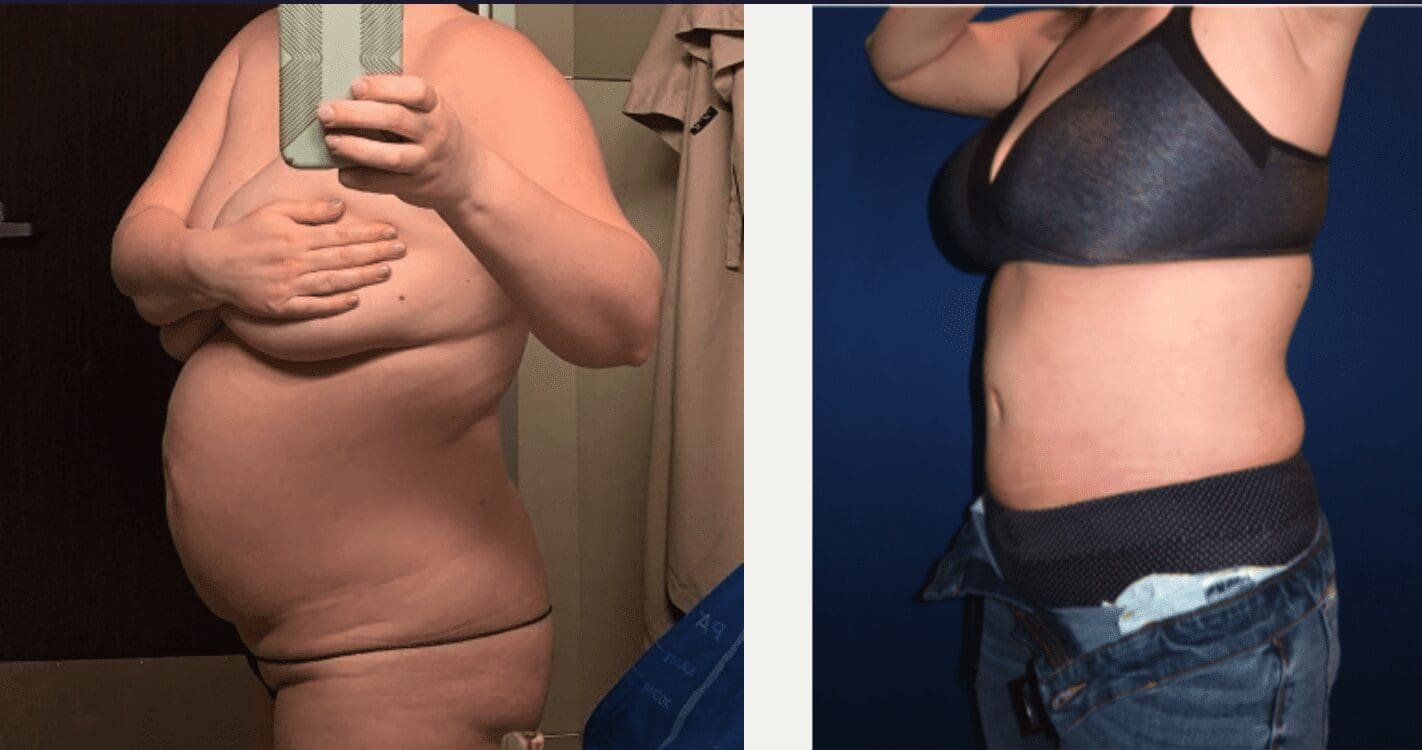 Mommy makeover before and after