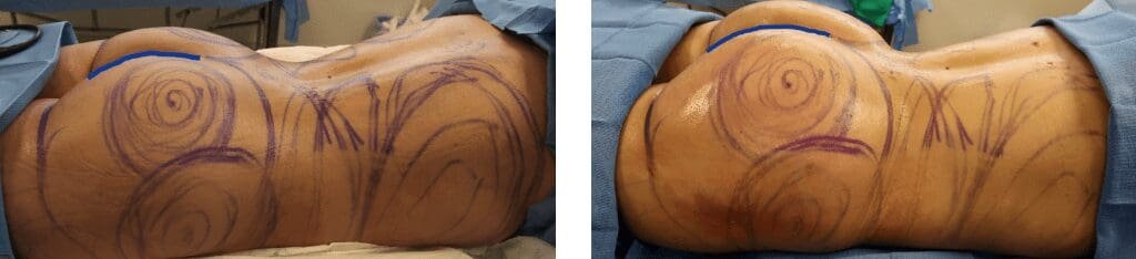 Brazilian butt lift before and after