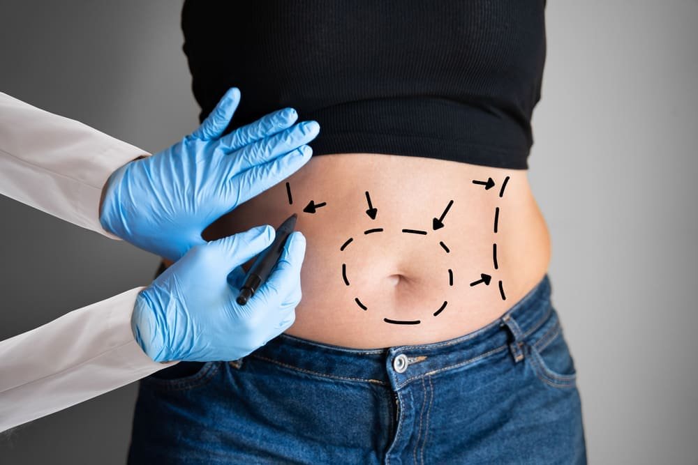 Abdominoplasty,obesity,surgery. ,aesthetic,abdominal,fat,liposuction