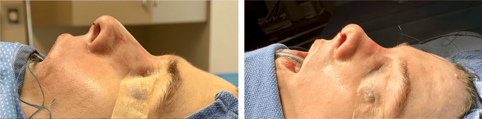 Rhinoplasty