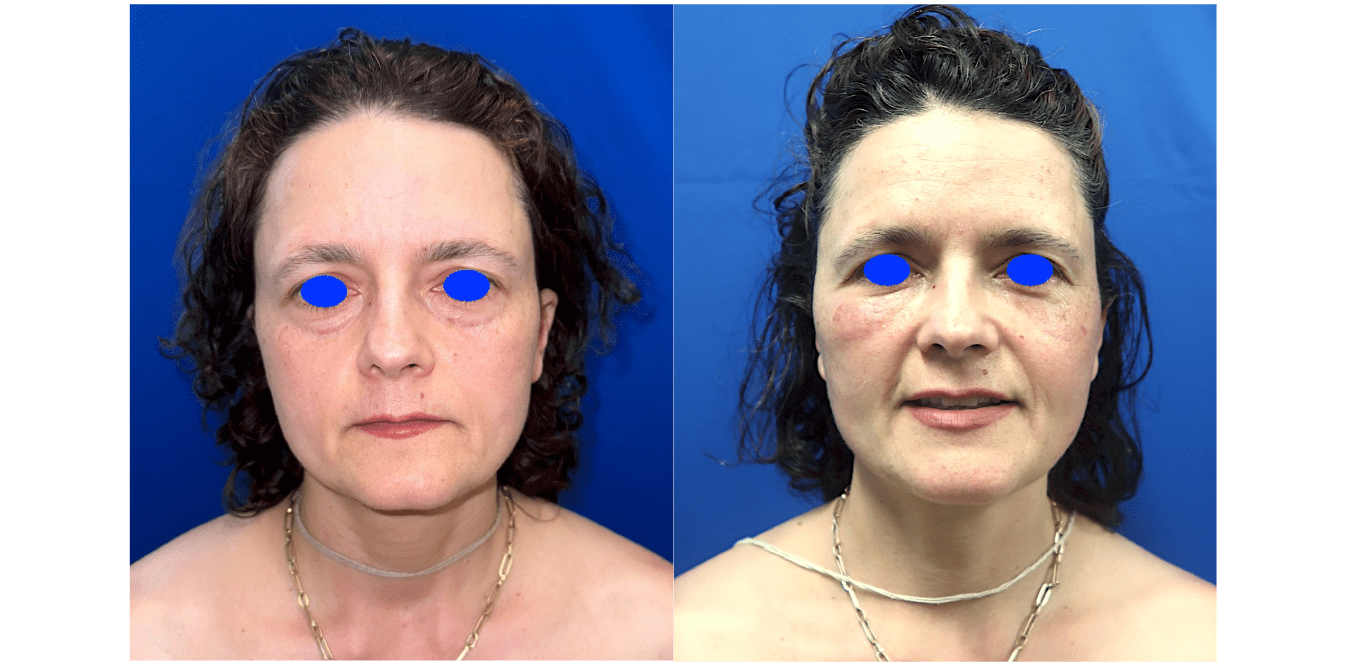 Before and after-02