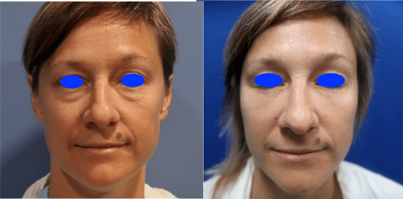 Before and after-04