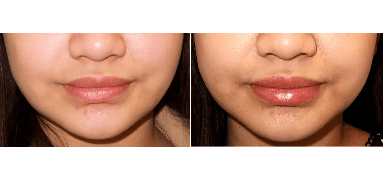 Before and after