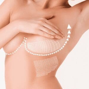 Galaflex “internal bra” breast suspension