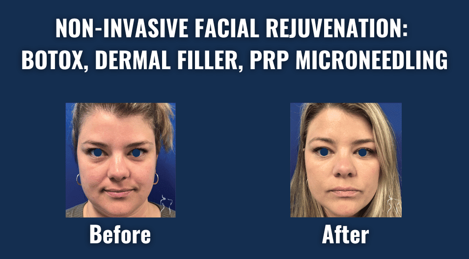 Discover facial rejuvenation: enhance your natural beauty at pacific sound plastic surgery