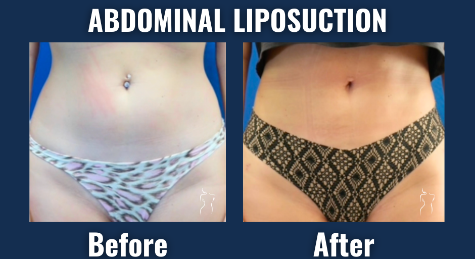 Before and after results of abdominal liposuction showing flatter stomach and defined waistline in a female patient.