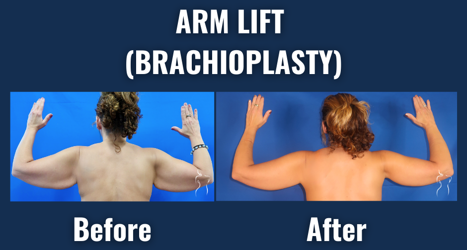 Before and after results of arm lift surgery (brachioplasty) showing significant reduction in upper arm sagging, viewed from the back.