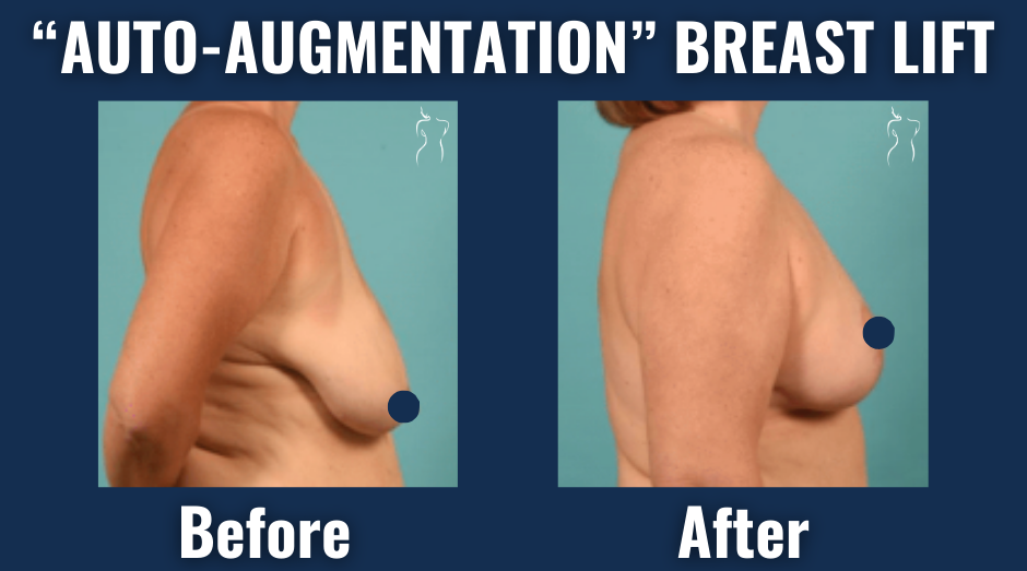 Before and after images of auto-augmentation breast lift showing enhanced breast projection and contour from side profile without implants.
