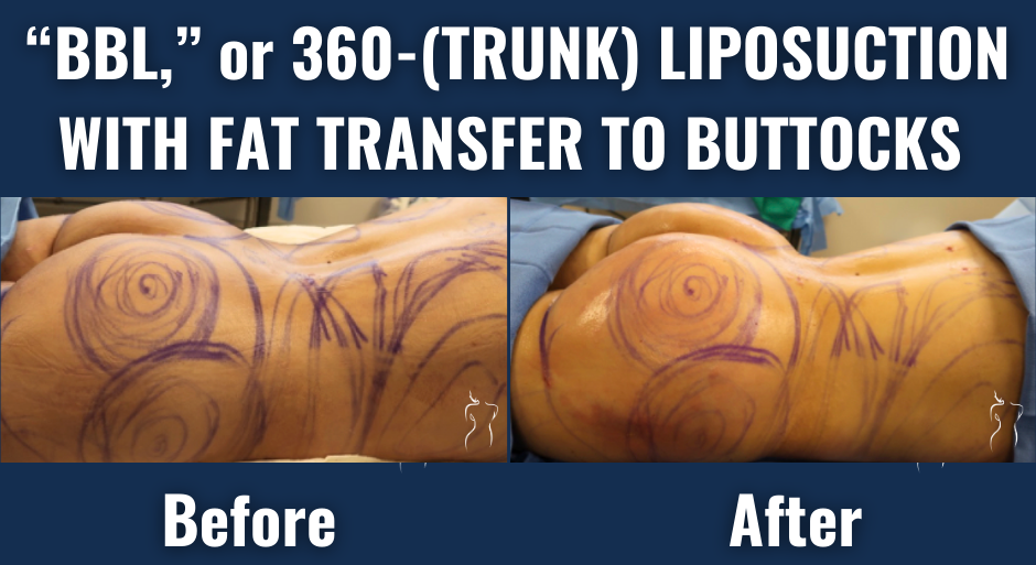 Before and after results of bbl with 360-degree trunk liposuction and fat transfer to buttocks showing improved body contour and enhanced gluteal volume.