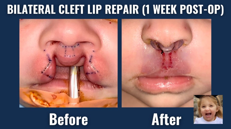 Before and after image showing bilateral cleft lip repair in an infant one week after surgery, with visible improvements in lip alignment and structure.