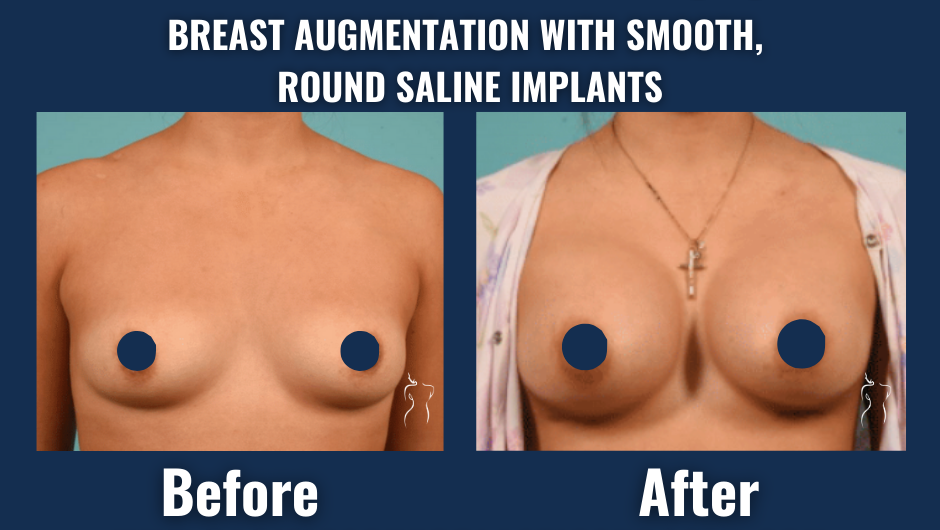 Before and after results of breast augmentation with smooth, round saline implants showing enhanced breast volume and contour from the front view.
