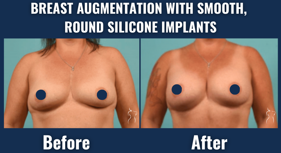 Before and after results of breast augmentation with smooth, round silicone implants showing increased breast size and improved contour.
