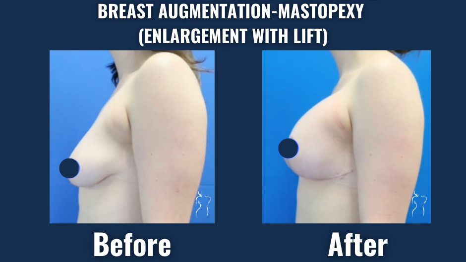 Before and after side profile showing results of breast augmentation with lift (mastopexy) using implants.
