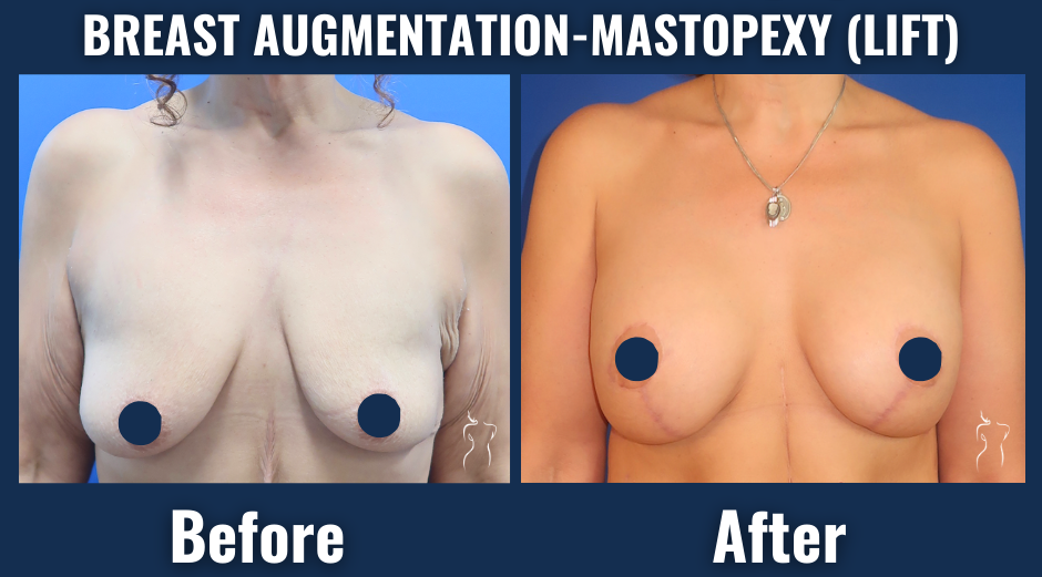 Before and after photo of a breast augmentation-mastopexy (lift) procedure showing improved breast shape, symmetry, and volume.