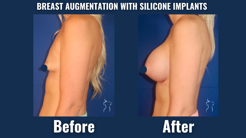Visual comparison of breast augmentation results with silicone implants, demonstrating increased breast volume and improved body contour while maintaining natural appearance.