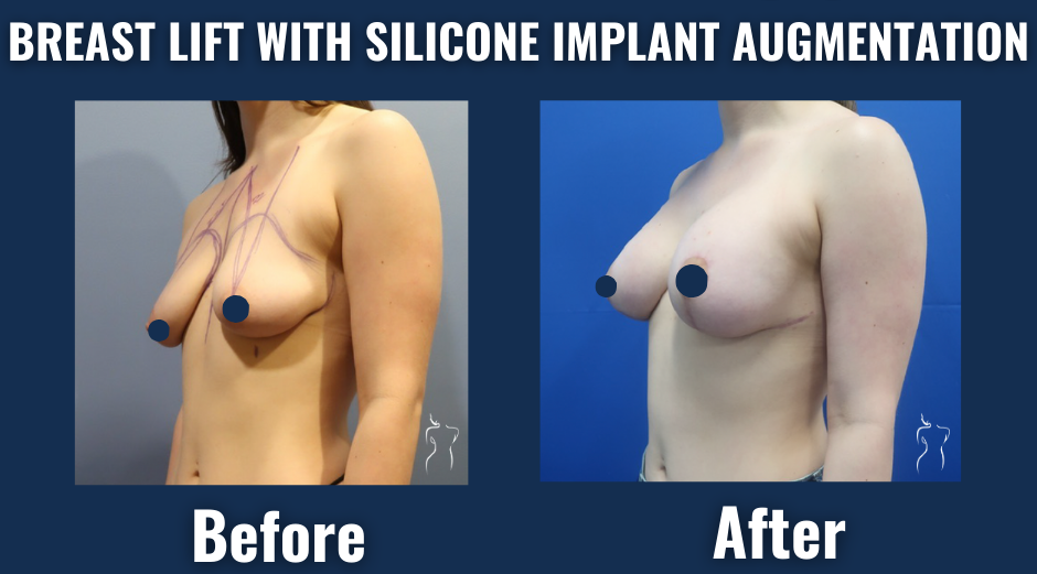 Before and after side view of breast lift with silicone implant augmentation showing enhanced breast shape, volume, and lifted position.