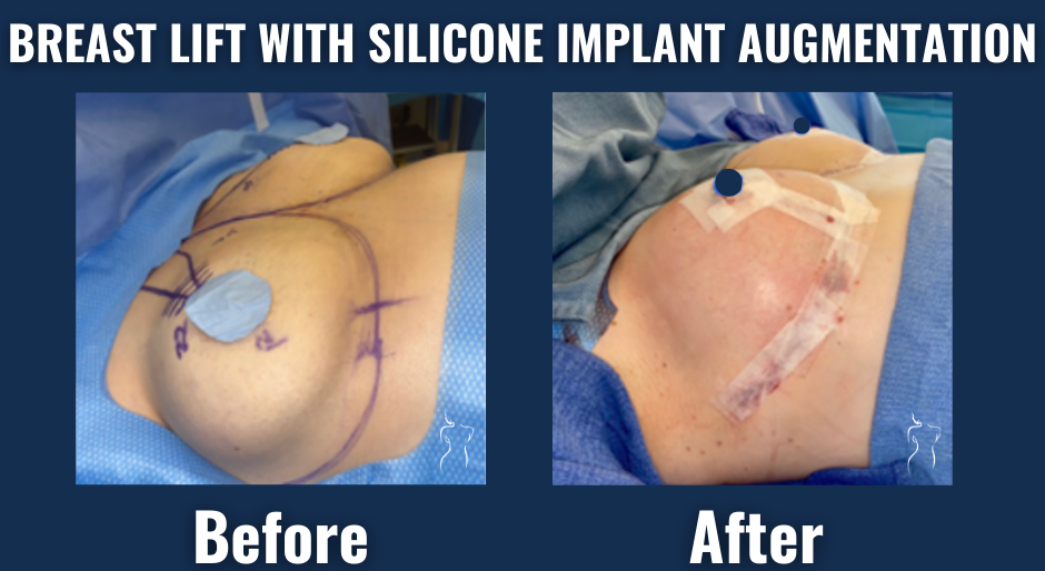 Before and after surgical view of breast lift with silicone implant augmentation showing improved breast volume and contour.