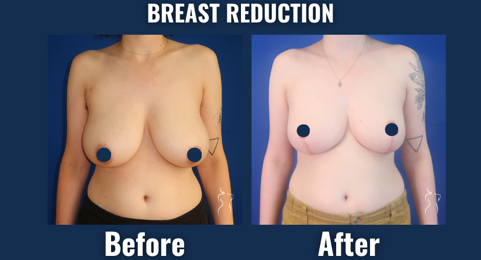 Front view before and after breast reduction surgery showing smaller, lifted breasts with improved symmetry.
