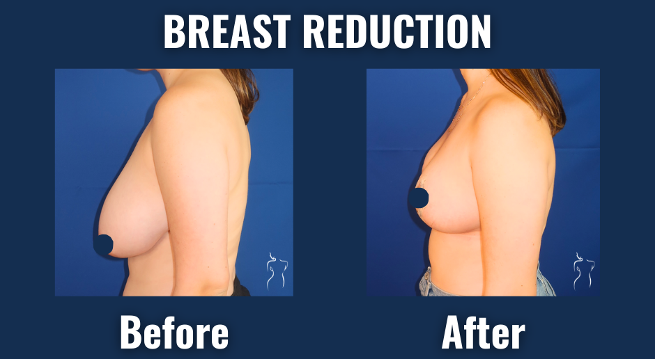Side view before and after results of breast reduction surgery showing lifted, smaller breasts and improved body contour.