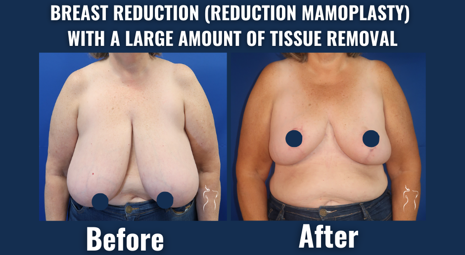 Breast-reduction-reduction-mammoplasty-large-tissue-removal-before-after