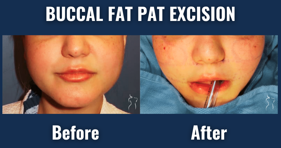 Before and after images of buccal fat pad excision showing cheek reduction and improved facial contour in a female patient.