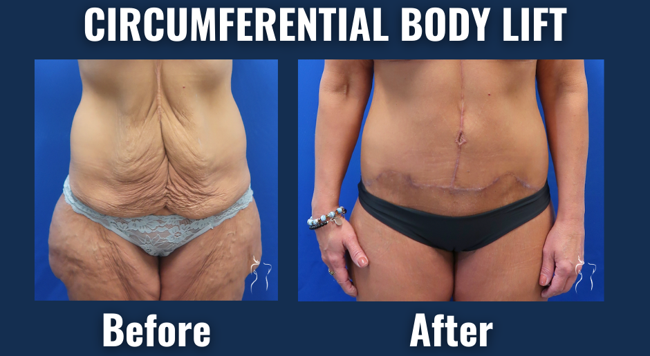Before and after results of circumferential body lift surgery showing removal of sagging skin and improved body contour in a female patient after weight loss.