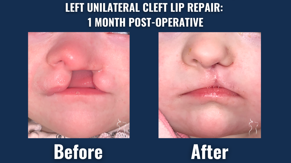 Before and after images of an infant showing the results of left unilateral cleft lip repair one month after surgery.