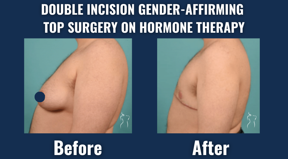 Before and after images of double incision gender-affirming top surgery showing a flat, masculine chest in an ftm patient on hormone therapy.