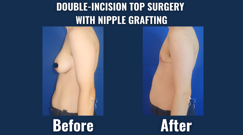 Gender-affirming surgery (ftm/n top surgery before & after)