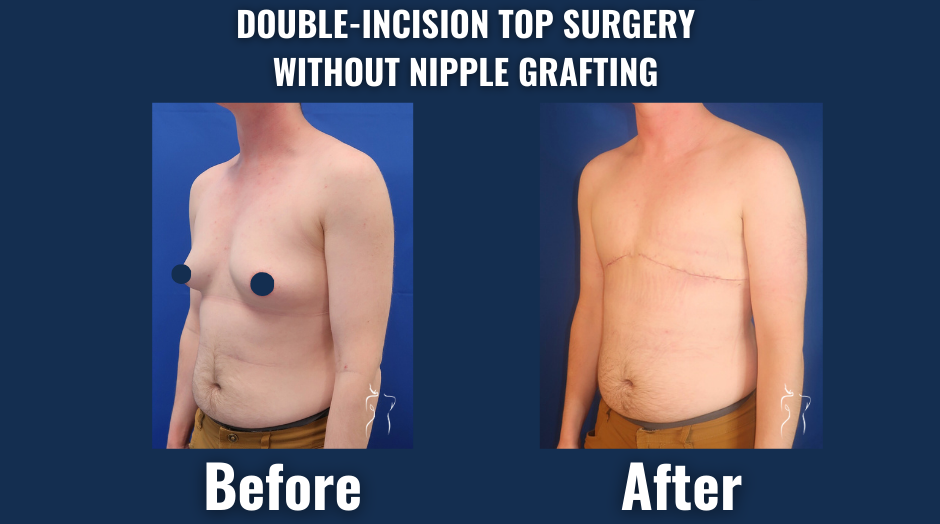 Comparison of chest appearance before and after double-incision top surgery without nipple grafting, showing a flat masculine contour and healed incision lines.