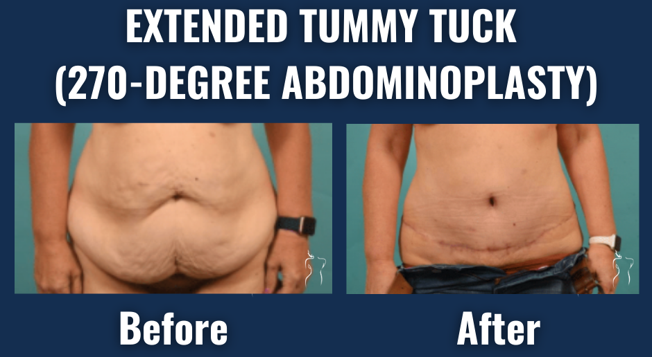 Before and after results of extended tummy tuck (270-degree abdominoplasty) showing improved abdominal shape and removal of loose skin in a female patient.