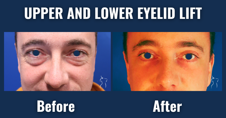 Before and after photos of male upper and lower eyelid lift (blepharoplasty) showing reduced puffiness and youthful eye contour.