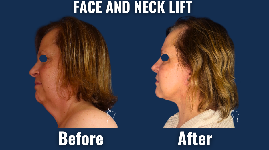 Before/after comparison of a face and neck lift, demonstrating natural rejuvenation of the lower face, sharper jawline, and smoother neck contours.