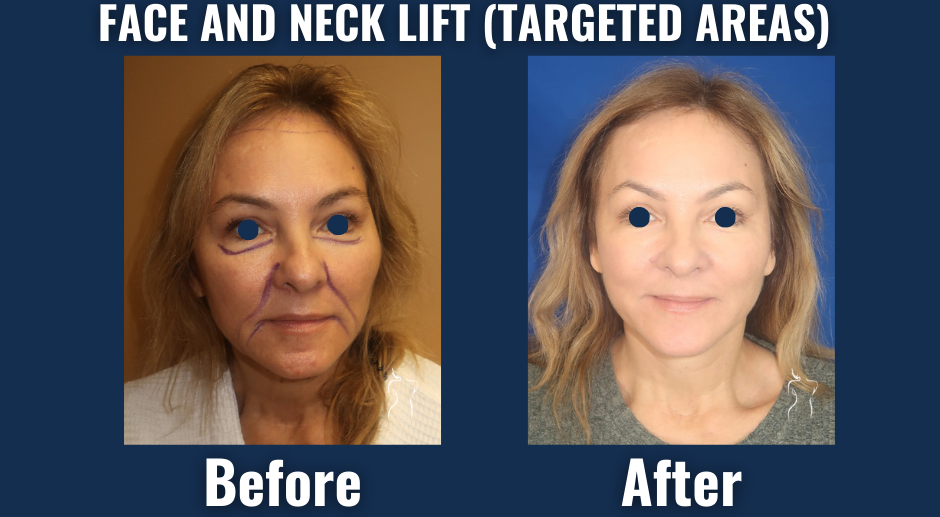Visual comparison showing rejuvenating effects of a face and neck lift, with enhanced jawline definition, smoother neck contours, and natural-looking facial refreshment.