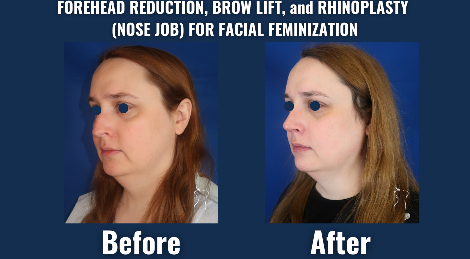 Side-by-side before and after image of facial feminization surgery showing changes to the forehead, brows, and nose.