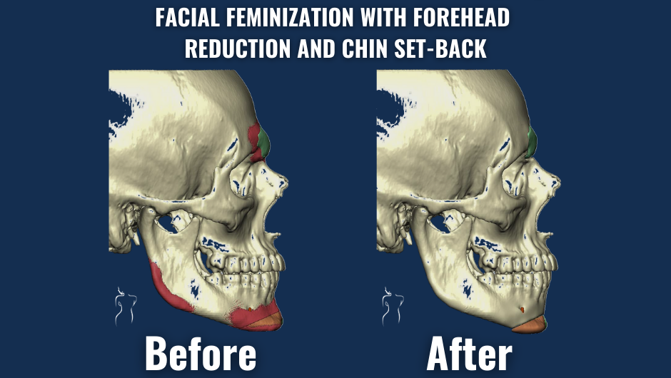 X-ray view showing before and after results of facial feminization surgery with forehead contouring and chin setback.