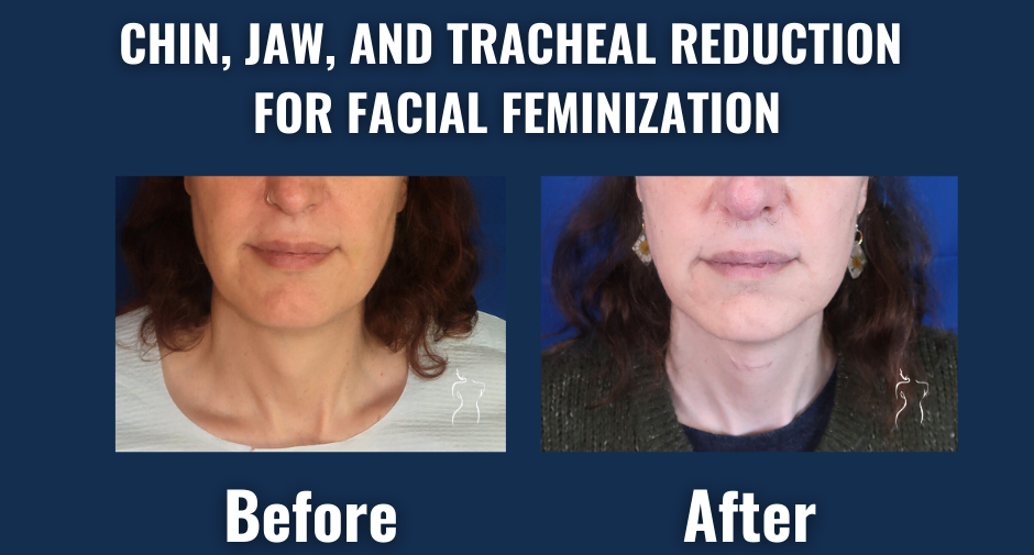 Facial-feminization-surgery-chin-jaw-tracheal-reduction-before-after