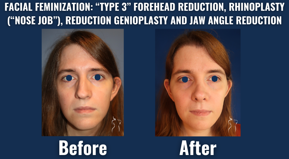 Before and after image of facial feminization surgery including type 3 forehead reduction, rhinoplasty, jaw angle reduction, and chin contouring.