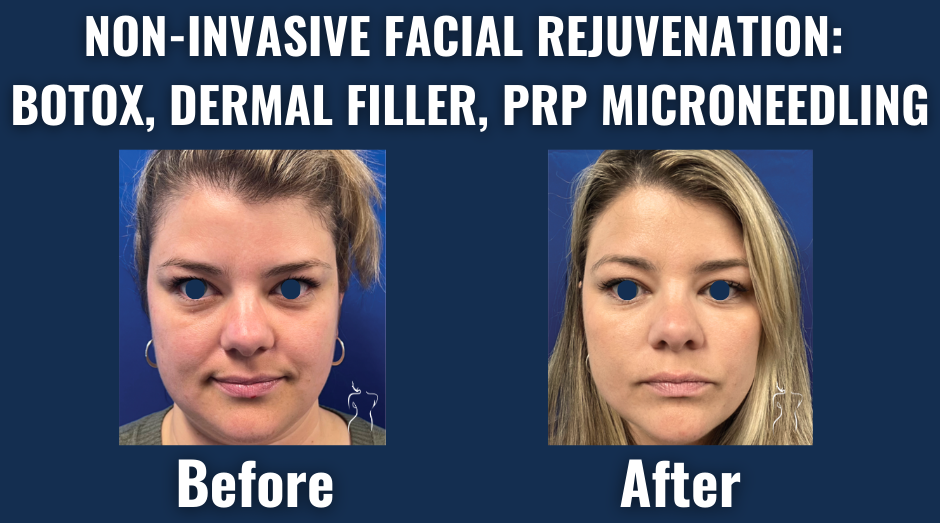 Before and after results of non-invasive facial rejuvenation with botox, dermal filler, and prp microneedling showing enhanced skin texture and youthful volume.