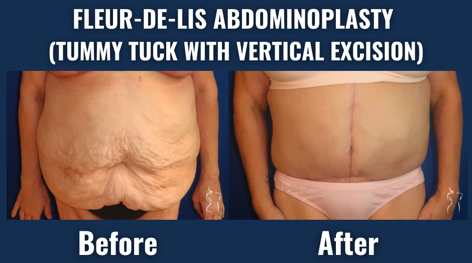 Before and after images of fleur-de-lis abdominoplasty showing vertical and horizontal excision for enhanced abdominal contour and excess skin removal.