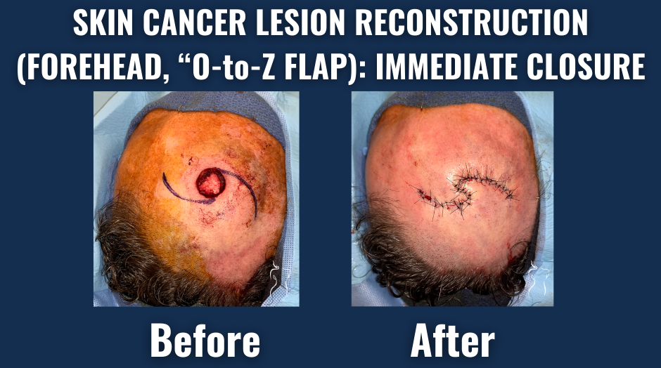 Before and after image of forehead skin cancer lesion repair using o-to-z flap technique for immediate surgical closure.
