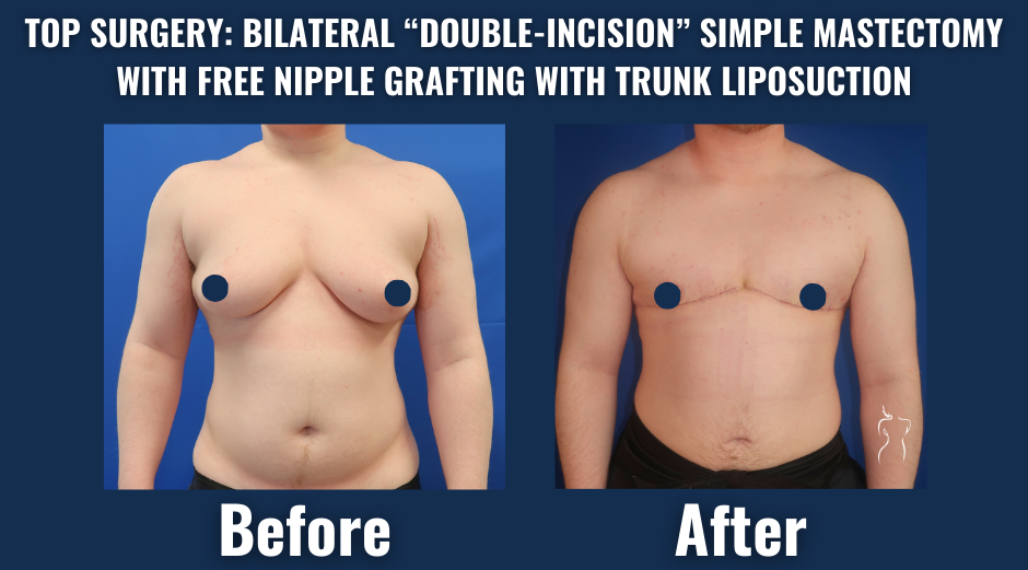 Before and after image of a transgender man showing results of top surgery with bilateral double-incision mastectomy and free nipple grafting, including trunk liposuction.