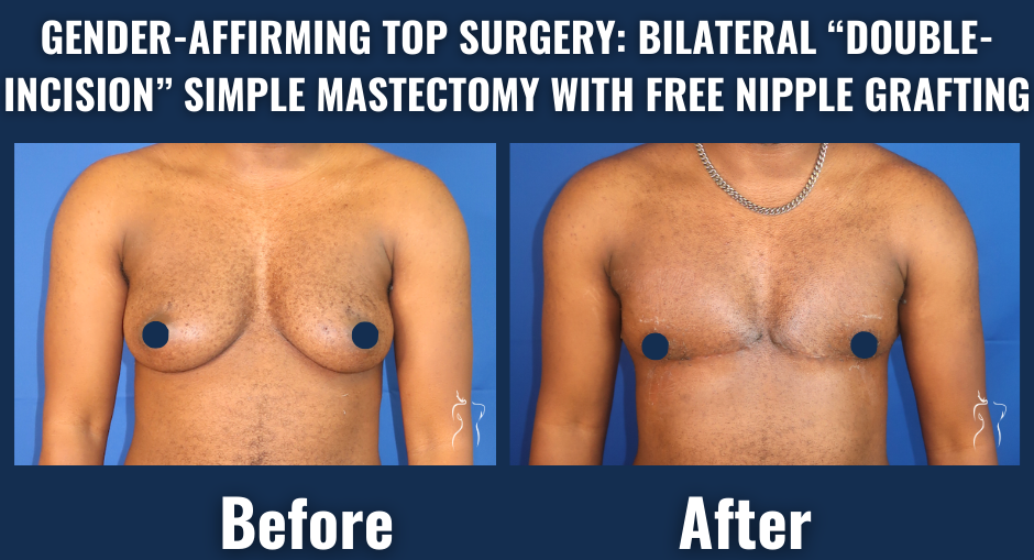 Before and after image of gender-affirming top surgery with bilateral double-incision mastectomy and free nipple grafting showing a flatter, masculinized chest.