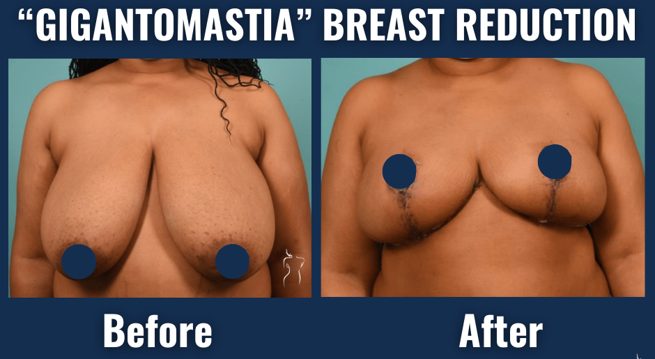Before and after images of breast reduction surgery for gigantomastia showing decreased breast volume and post-surgical contour improvement.