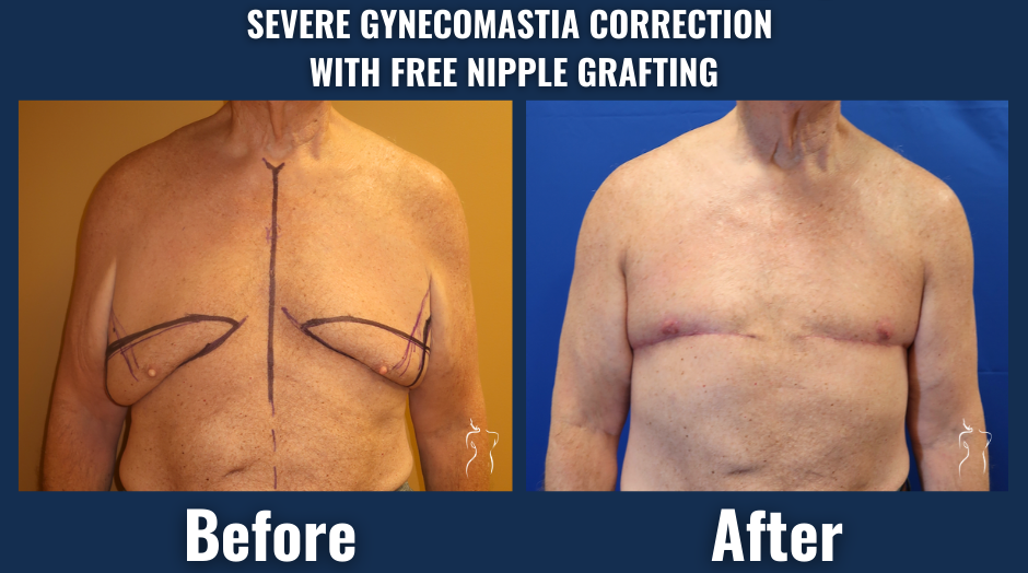 Before and after photos of severe gynecomastia correction with free nipple grafting, showing improved male chest contour and reduced breast tissue.
