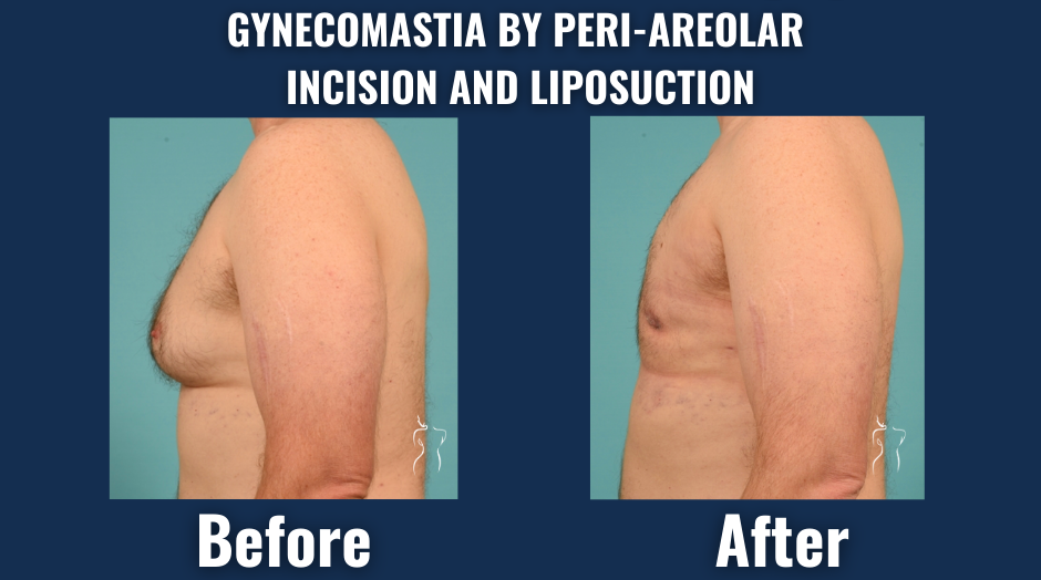 Before and after results of gynecomastia correction using peri-areolar incision and liposuction showing a flatter, more defined male chest.